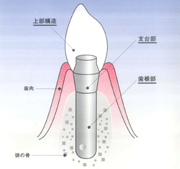 インプラントの構造